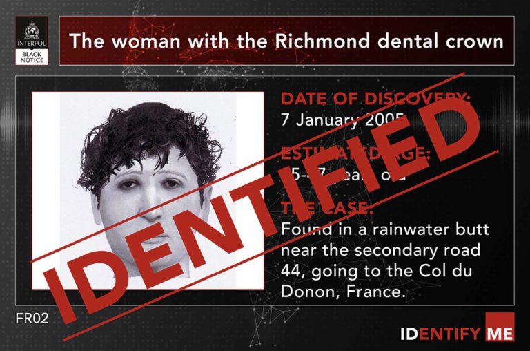 Richmond Dental Crown